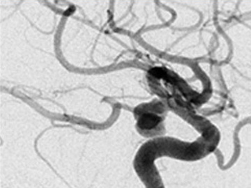 Rapidly growing PCOM-Aneurysm 