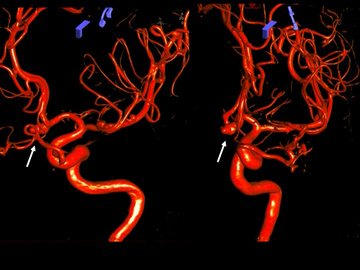 Recanalized Acom Aneurysm Treatment. Robotic Stent Assisted Coiling 