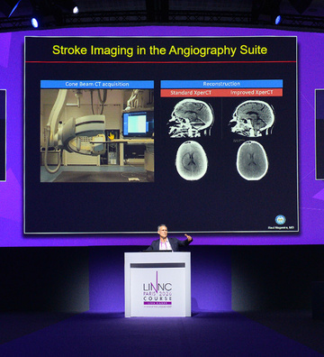 Day 3 Highlights from LINNC Paris 2026 – MeVO, improving outcomes after thrombectomy & MMA next frontiers