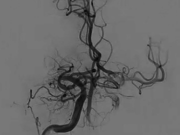 Removal of a 11cm thrombus!