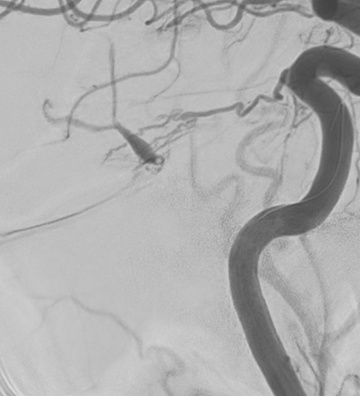 Retrograde transvenous embolization of a tentorial dural AV-Fistula