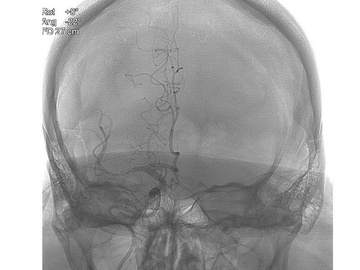 Right M1 occlusion with STAT technique