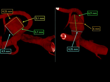 Right MCA aneurysm treated with balloon-assisted WEB