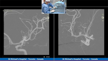 Right MCA aneurysm treated with intrasaccular flow diversion after two failed attempts