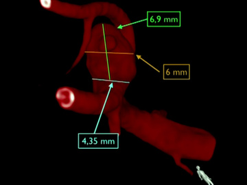 Right MCA aneurysm