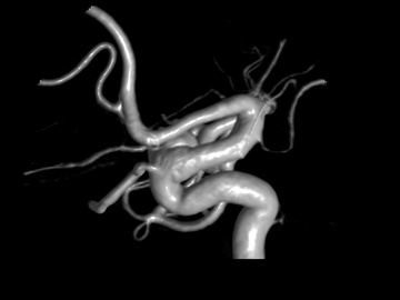 Right-sided paraophthalmic aneurysm treated with a Pipeline™ Vantage Shield using RIST™ Radial access System