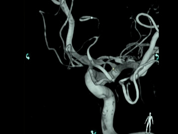 Ruptured anterior cerebral dissection aneurysm