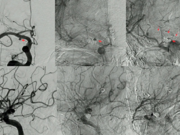 A case of ruptured blister-like ICA aneurysm at the non-branching site