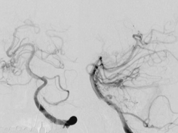 Ruptured Brain Stem AVM Causing vessel Perforation
