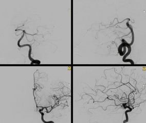 Ruptured Vermian AVM treated using Squid by venous approach
