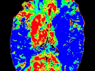 Simultaneous bilateral mechanical thrombectomies on a COVID-19 patient