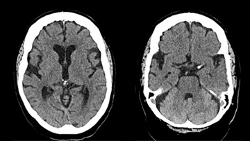 Single-pass large-bore aspiration for acute left carotid T occlusion