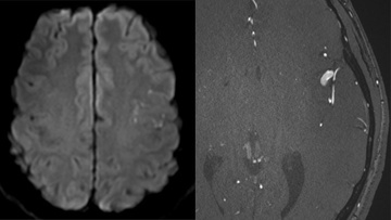 “Slow-deconstructive” approach in a patient with acute stroke and fusiform MCA aneurysm