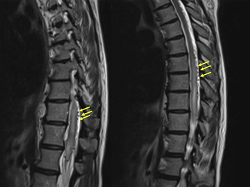 Spinal epidural arteriovenous fistula embolization