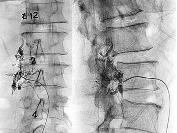 Spinal extradural arteriovenous fistula