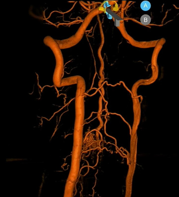 Spinal perimedullary AVM: an advanced transvenous approach