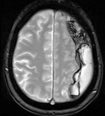 Subdural Hematoma: Preventing Recurrence with a Three-Step Onyx Embolization