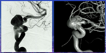 Supraclinoidal aneurysm treated with a FD and coiling through a jailed microcatheter