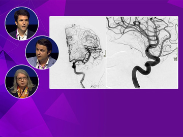 STRYKER symposium: Innovative aneurysm treatments