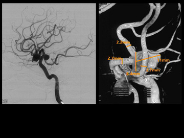 T-stent-assisted coiling of a complex Acom aneurysm