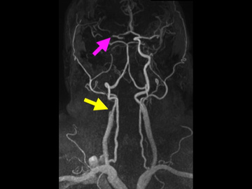 Tandem occlusion with workflow issue