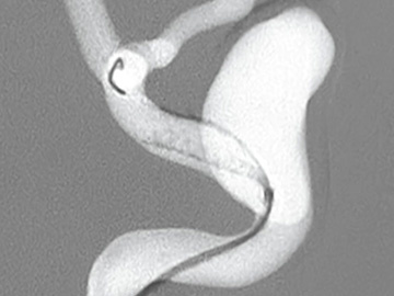  Memories of aneurysm treatment 