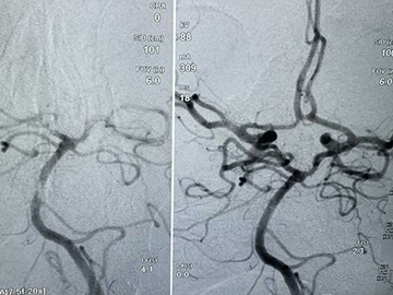 Third stroke patient treated with Cyclical Aspiration 