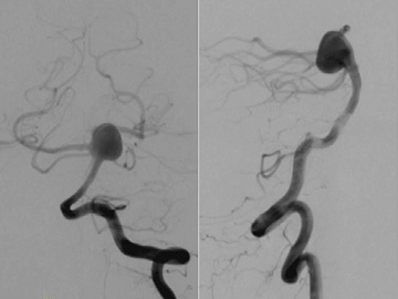 Endovascular treatment of the superior cerebellar artery