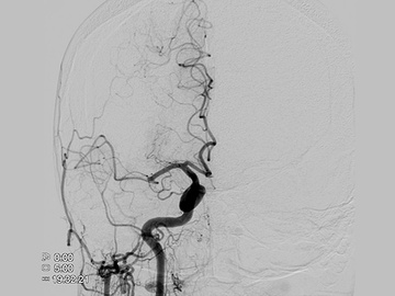 Thrombectomy - ADAPT with Snake bite technique