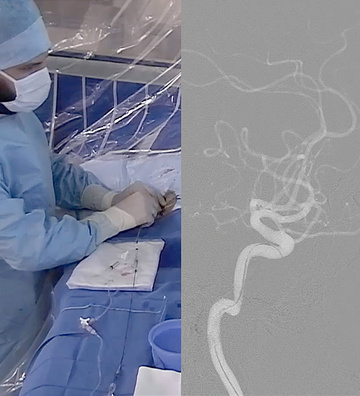 Timely recanalization of a left M2 occlusion in a low-NIHSS stroke