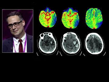 Towards a one-stop shop for stroke therapy: a Philips symposium