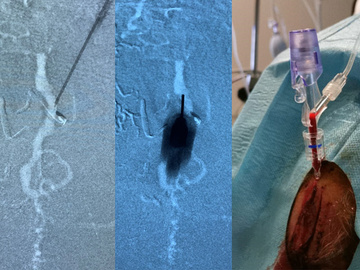 Transcranial embolization of a superficial DAVF