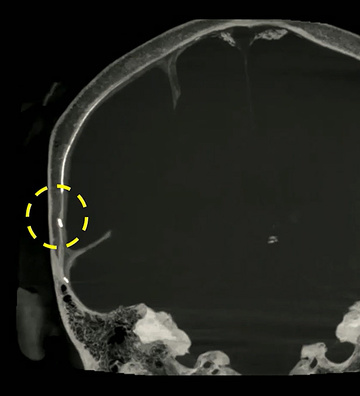 Transvascular access: a new frontier in CSDH care