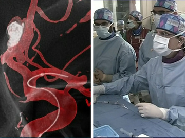 Live Case: Treating a recurrence of an Acom aneurysm using flow diversion