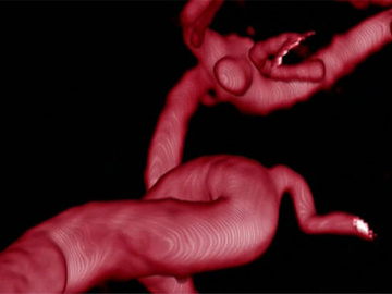 Treating a recurrence of an Acom aneurysm using flow diversion