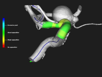 Treating a right ICA aneurysm using an EVOLVE flow diverter