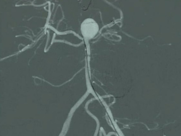 Treatment of a big basilar artery