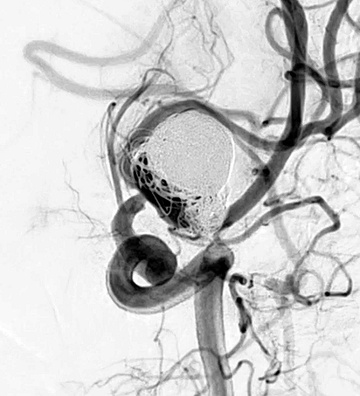 Treatment of a previously ruptured aneurysm with multiple recurrence