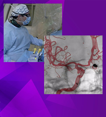 Treatment of an unruptured PCOM aneurysm with a flow-diverter stent