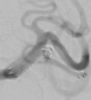 Treatment of left MCA aneurysm
