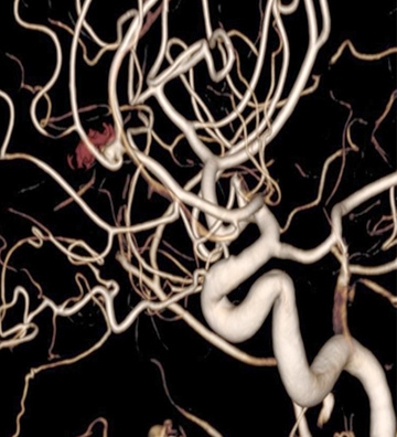 Treatment of recanalized pericallosal artery aneurysm
