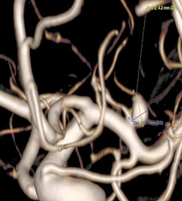 Treatment of ruptured MCA aneurysm