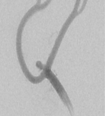 Treatment of ruptured pericallosal anterior cerebral artery aneurysm