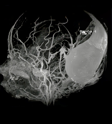 Two-stage treatment of a dural sinus malformation in a 12-week-old baby