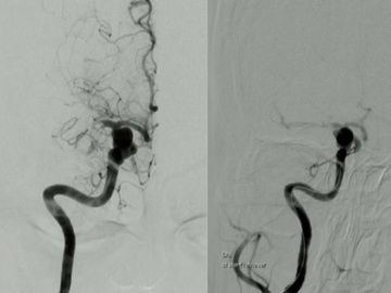 Unruptured intracranial aneurysm: a rare cause of stroke