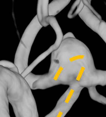 Use of a unique distal-shaped microcatheter in the treatment of a wide-neck Acom aneurysm