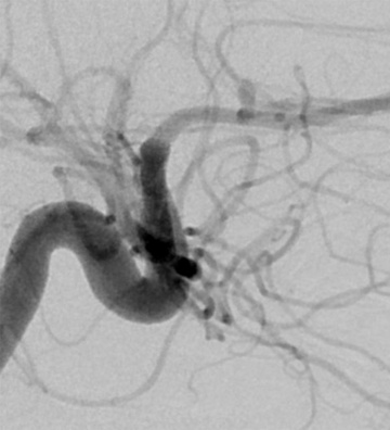 Versatile coil used to treat a ruptured right A1-A2 junction aneurysm