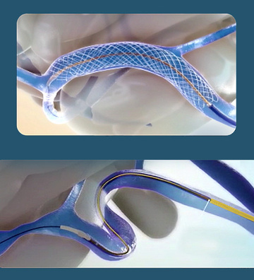Vflow Symposium - Viva Stent feasibility study