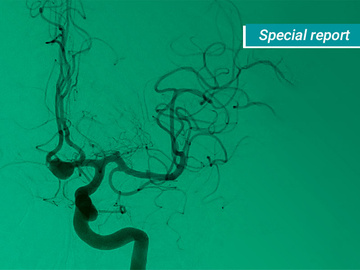 WEB device: Pioneering the intrasaccular revolution