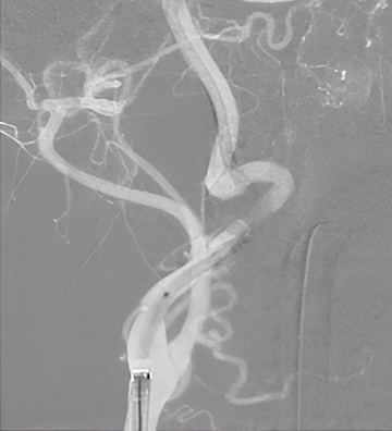 Wide-neck MCA aneurysm with severe carotid tortuosity